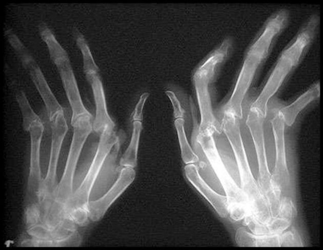 X -RAY pilt artroosist mõjutatud kätest