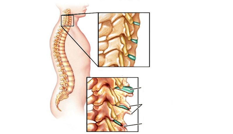 Osteokondroosi sündroomid